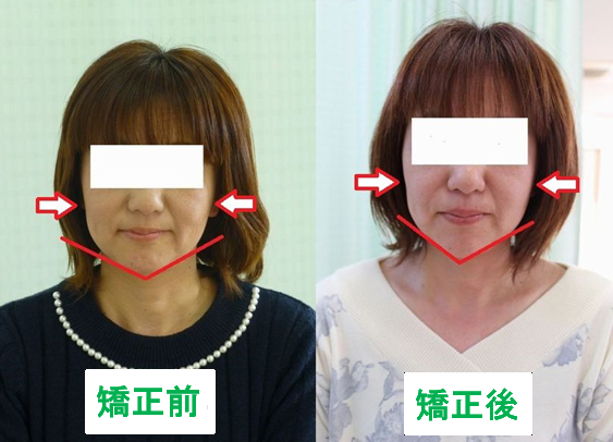 小顔矯正ビフォーアフター画像.png