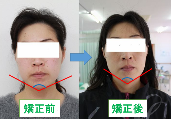 小顔矯正ビフォーアフター.png
